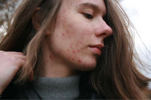 A close up of a woman with acne